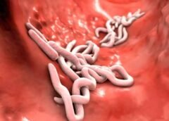 ¿Cómo saber si es colitis o parásitos intestinales?